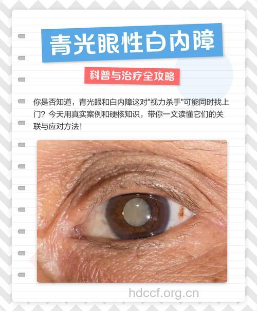 如何治疗原发性青光眼合并白内障