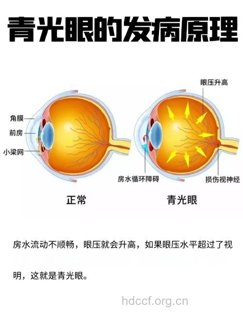 如何正确应对青光眼