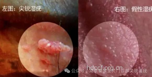 女性阴道镜检查 尖锐湿疣的6种检查方法