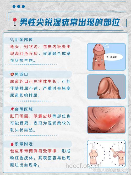 男性患上尖锐湿疣的四大原因