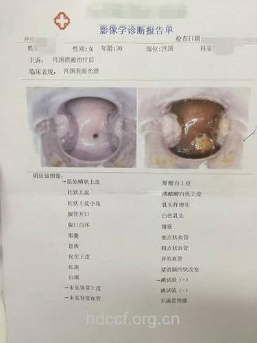 尖锐湿疣做阴道镜的意义