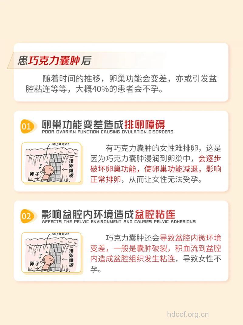 巧克力囊肿会导致不孕吗