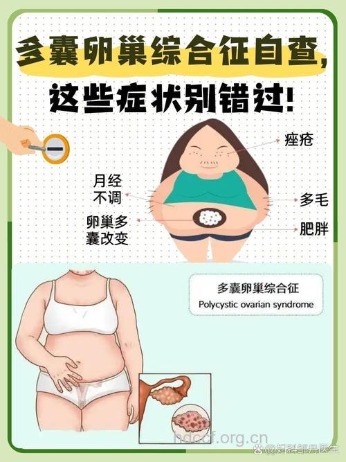 多囊卵巢有何症状表现