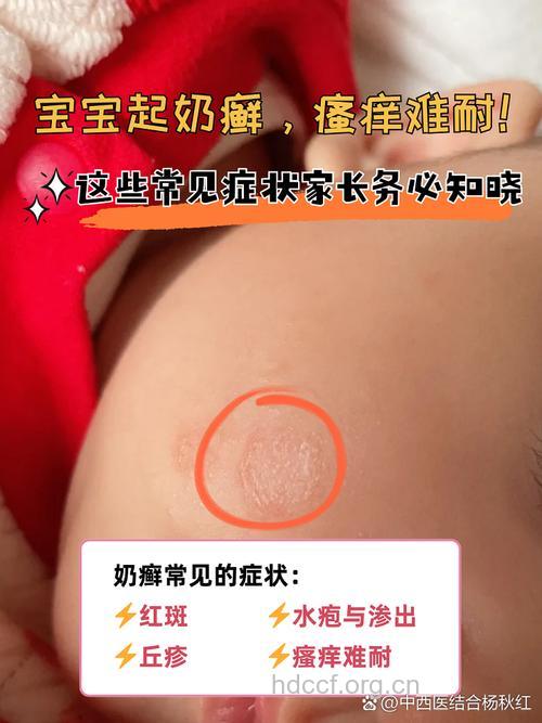 宝宝奶癣反复发作 从四个方面入手