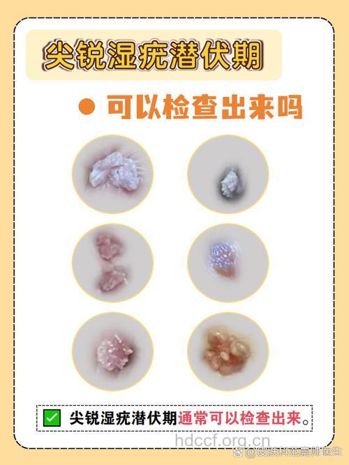 尖锐湿疣的潜伏期有多长