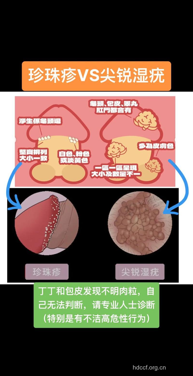 尖锐湿疣早期症状 男女有何差异