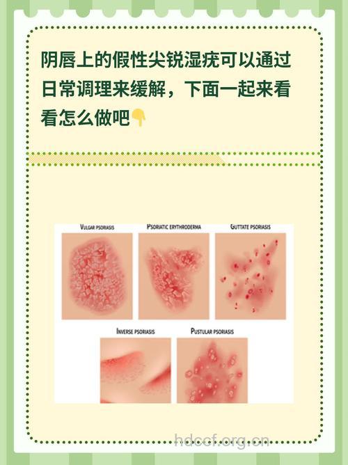 外阴尖锐湿疣的常用治疗方法