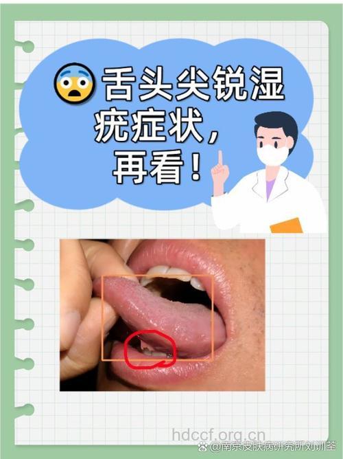 口腔尖锐湿疣的诊断方法