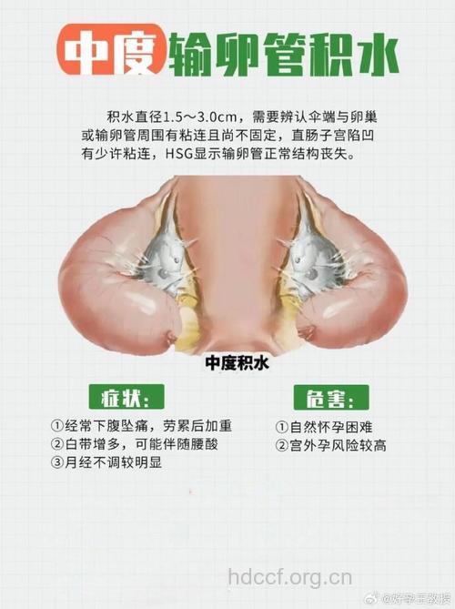 输卵管积水的治疗方法