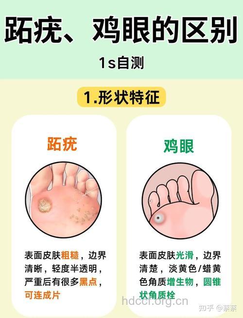 当心!足浴也会感染尖锐湿疣