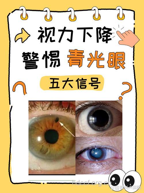 气温骤降会引起青光眼吗