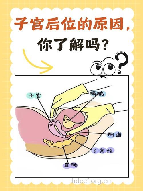 子宫后位易致女性不孕
