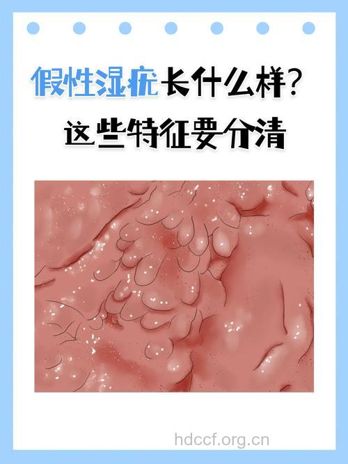 假性尖锐湿疣的3个症状特点