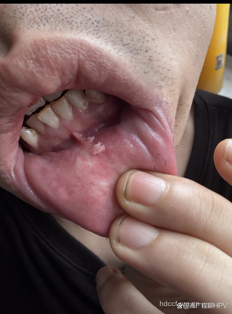 口腔尖锐湿疣的症状有哪些