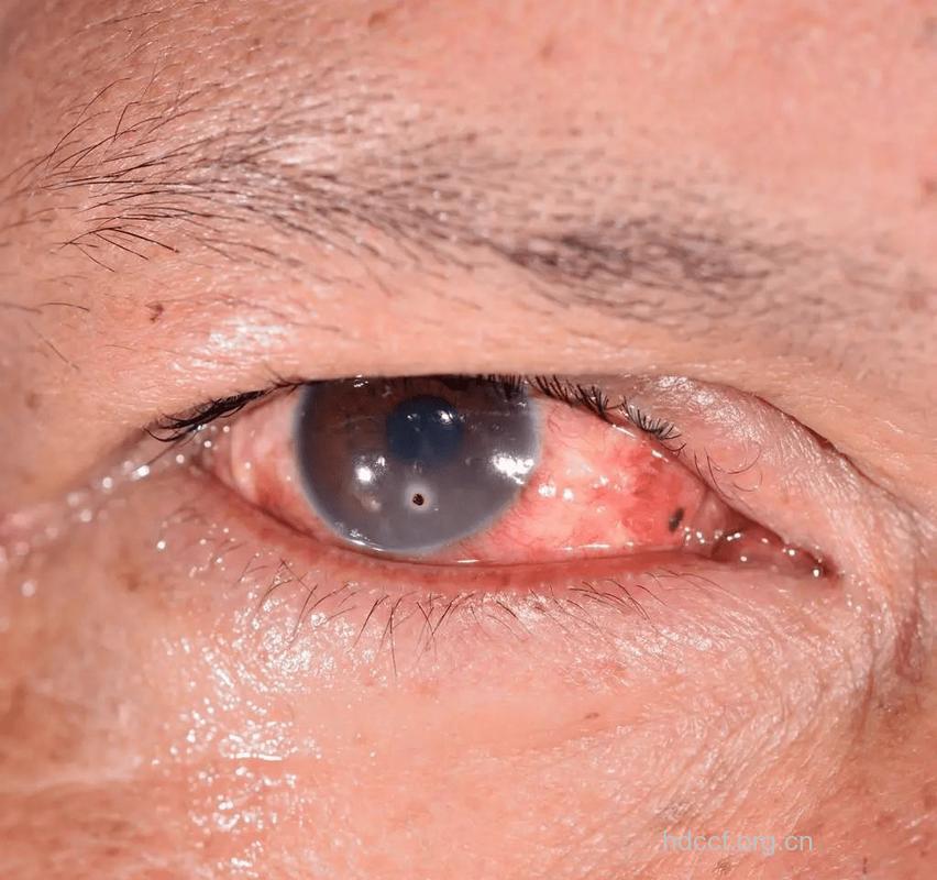 外伤性白内障有哪些症状