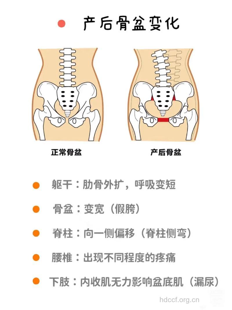 女性骨盆狭窄可能会致使不孕