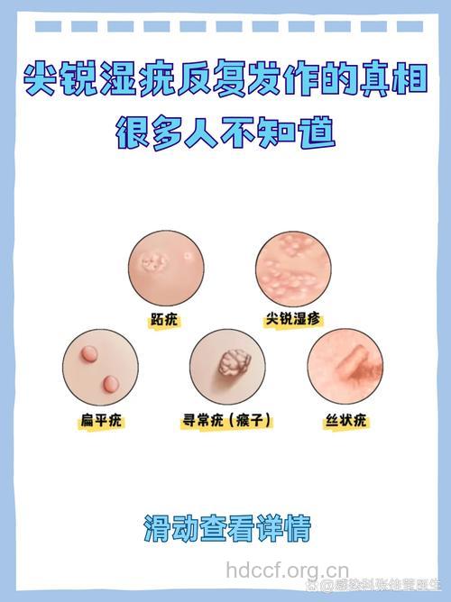 尖锐湿疣复发的症状你了解哪些