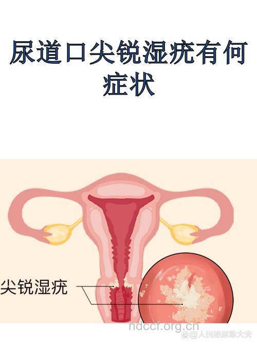 男性尖锐湿疣的尿道症状