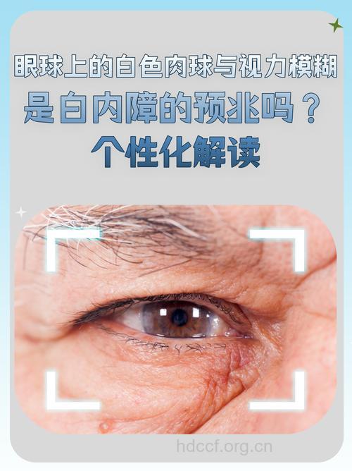出现视物模糊是白内障吗