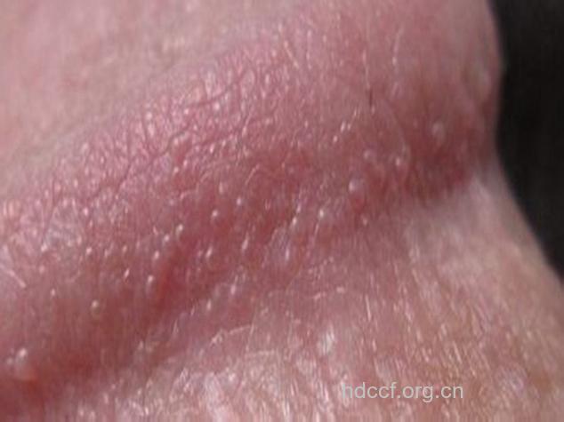 尖锐湿疣的初期表现