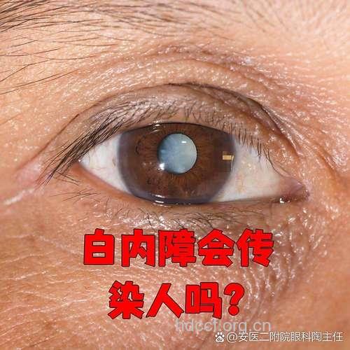 先天性白内障的表现