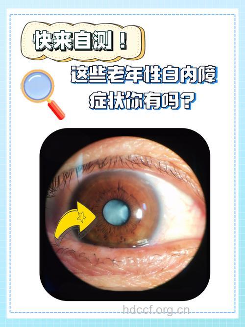 老年性白内障的临床症状