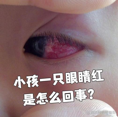 孩子揉眼睛小心患结膜炎沙眼