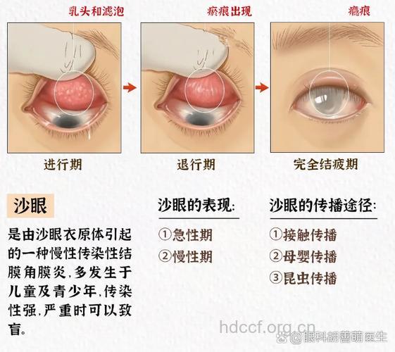 红眼病与沙眼的关系