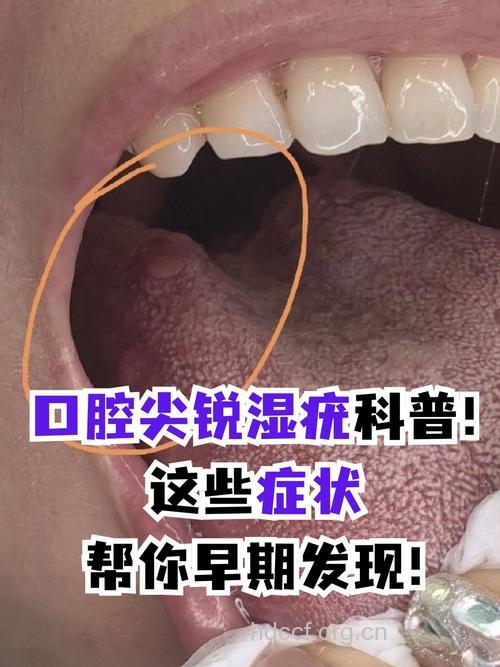 口腔为什么会导致尖锐湿疣