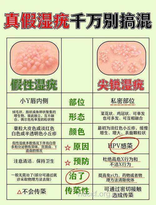 怎么用药治疗尖锐湿疣