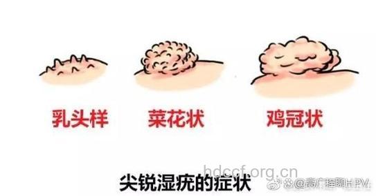 钞票为什么会导致尖锐湿疣