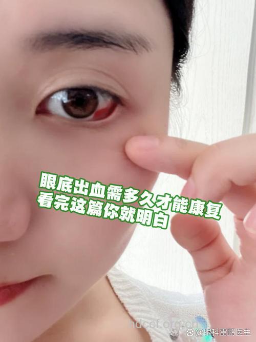 眼底出血小心引起青光眼