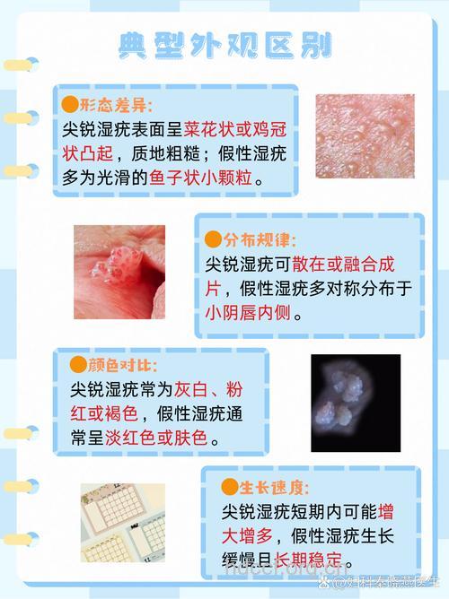 哪些疾病易与尖锐湿疣混淆