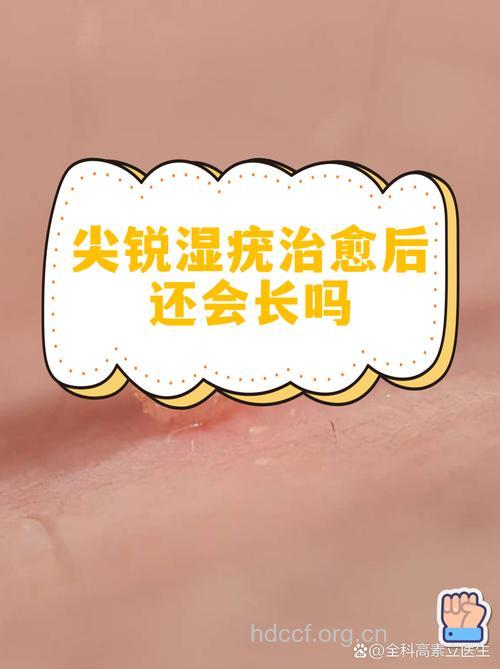 尖锐湿疣治愈后会复发吗