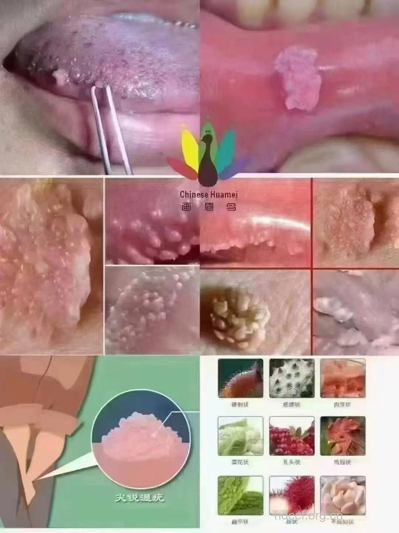 尖锐湿疣就是性病吗