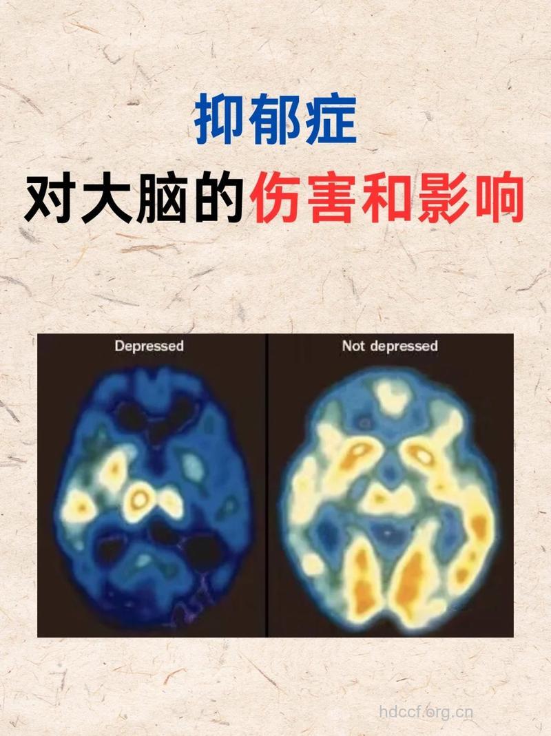 躁抑郁症的罪魁祸首 缺陷基因