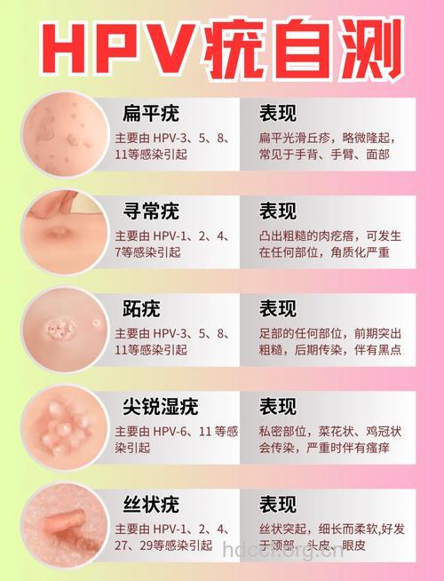 尖锐湿疣对女性有什么危害