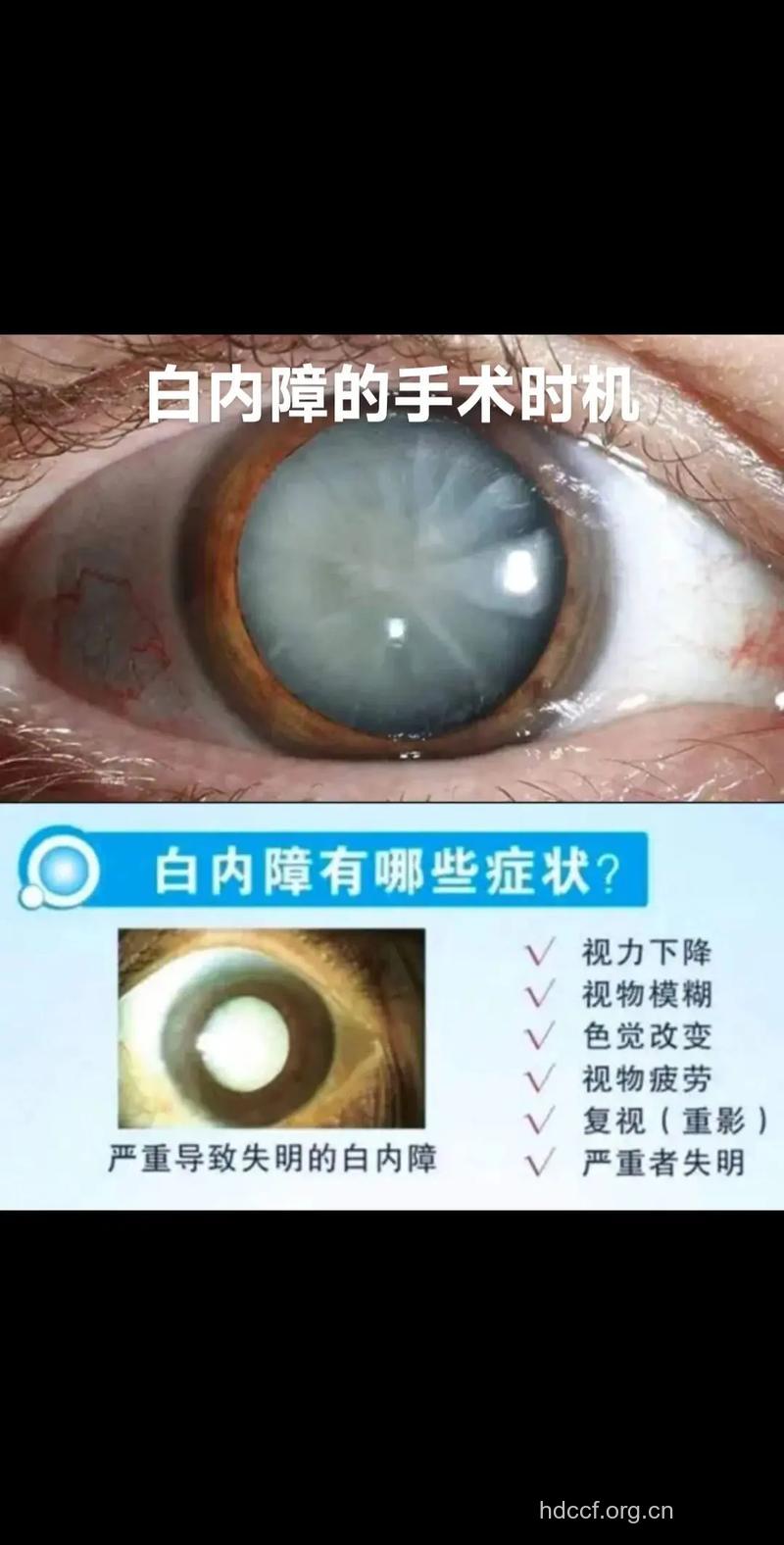 白内障手术需要好的时机