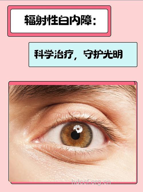光电辐射会诱发白内障吗