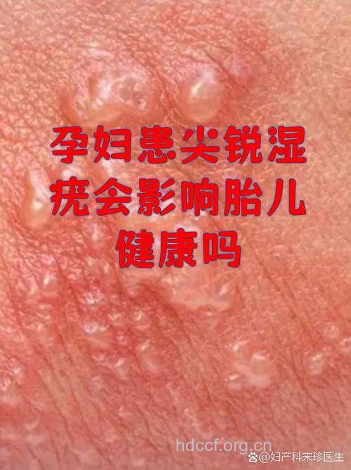 孕妇患尖锐湿疣要不要终止妊娠?
