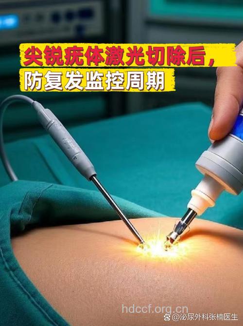 光动力疗法轻松攻克尖锐湿疣