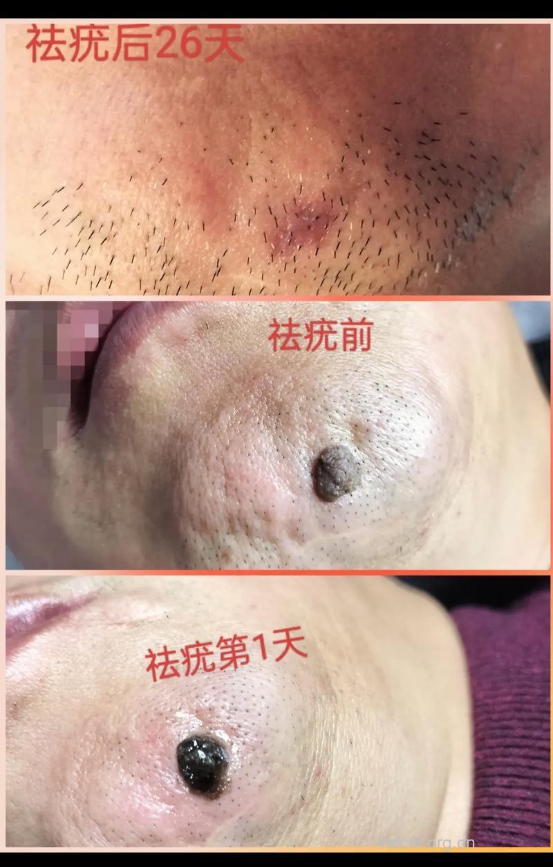 治疗尖锐湿疣中西医大PK