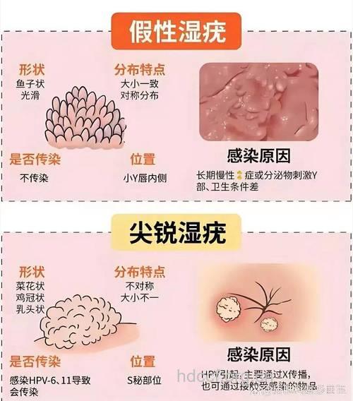 有性行为就得防尖锐湿疣
