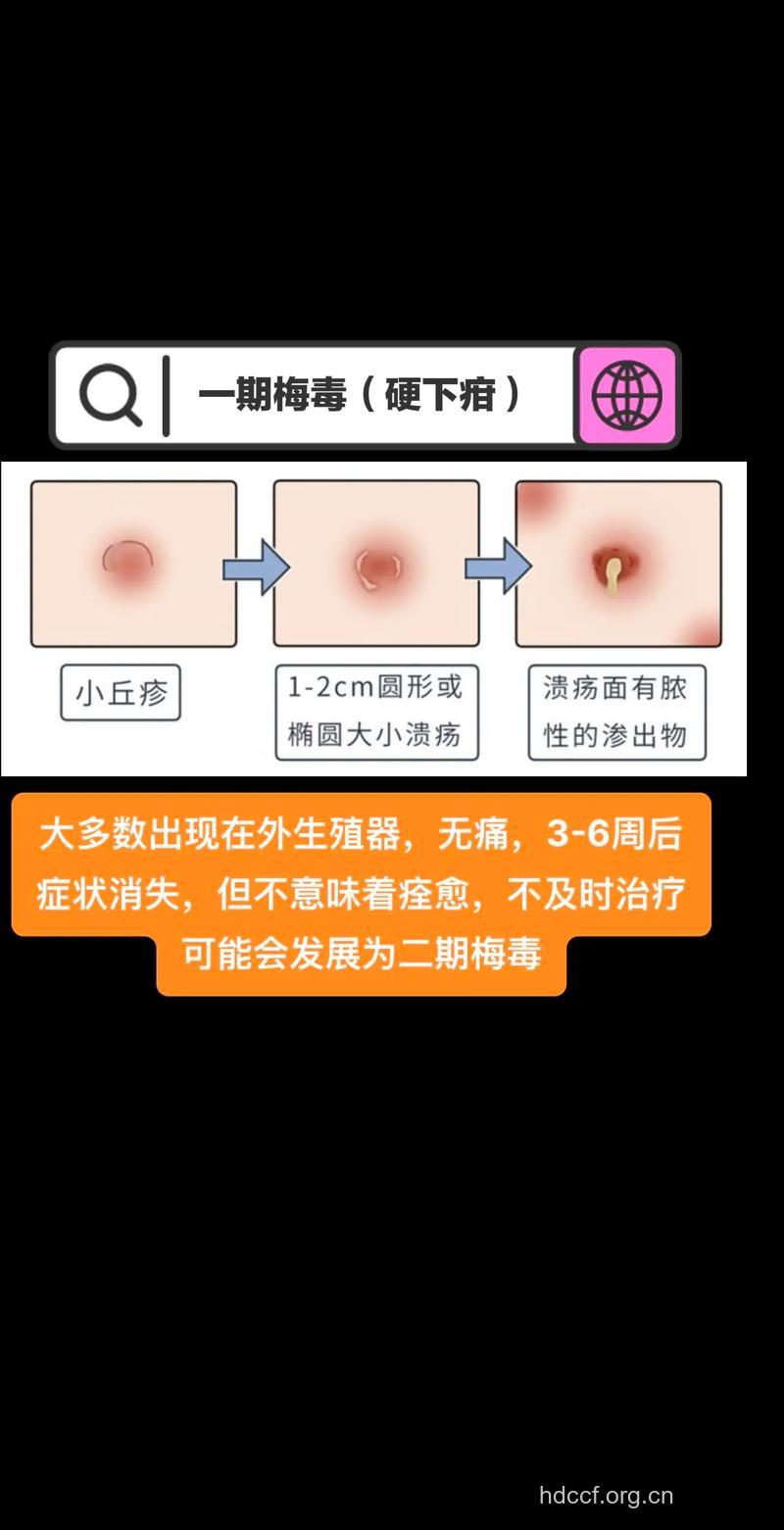 一期梅毒信号――硬下疳