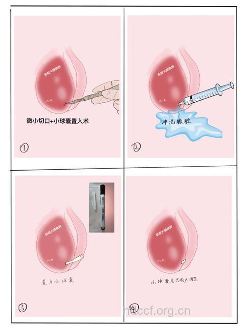 阴道囊肿有哪些诊治方法
