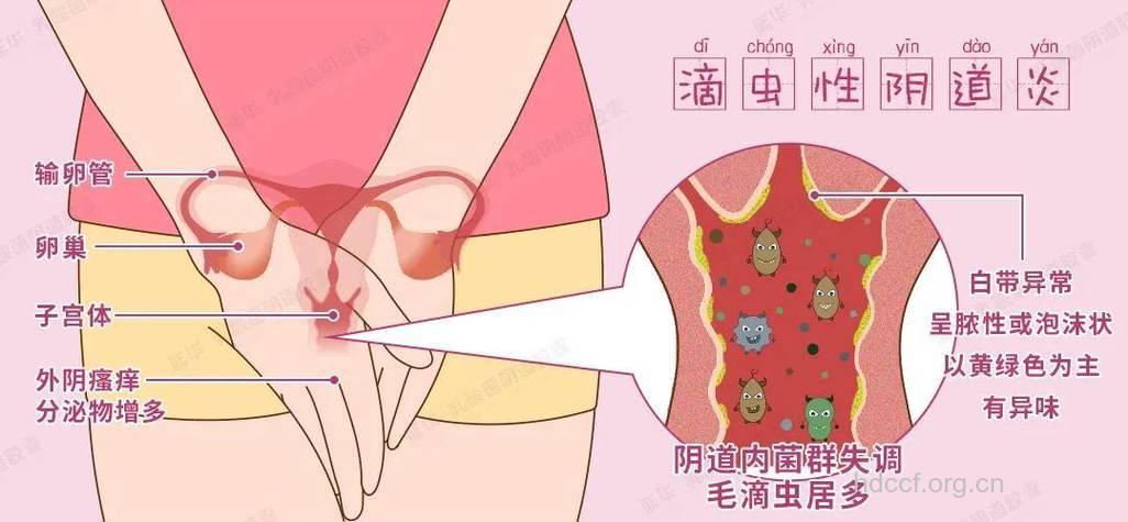 滴虫性阴道炎为什么会导致不孕