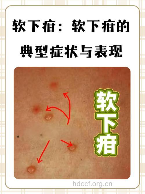 软下疳有哪些特点 易引起四大并发症