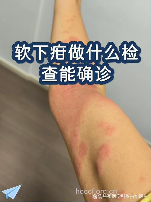 软下疳该如何检查确诊
