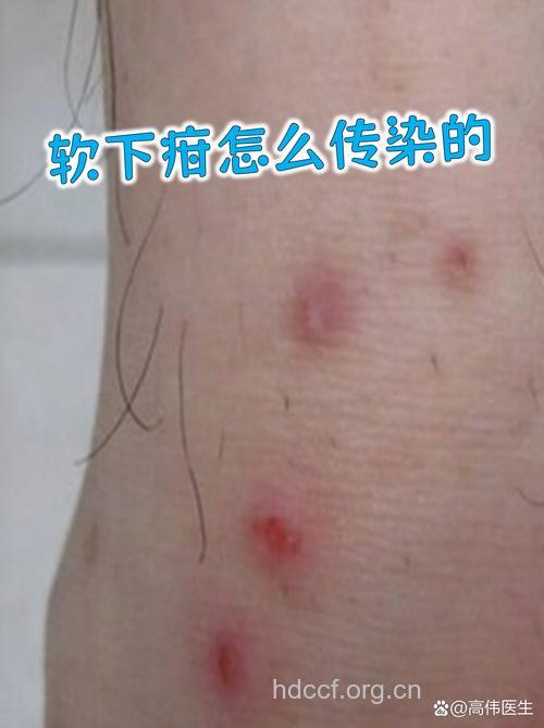 99%软下疳通过性接触传播