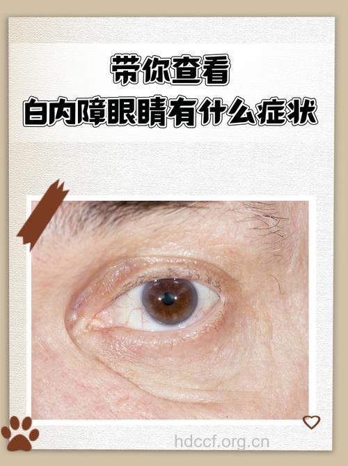 白内障有哪些自觉症状